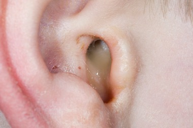 Ear infection (private)