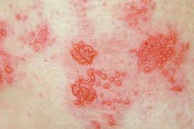 Shingles vaccination Private